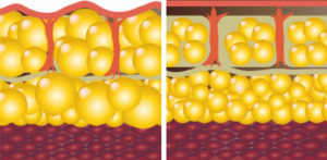 cellulite removal phoenix az